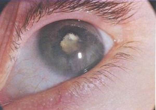 фото осложненной катаракты